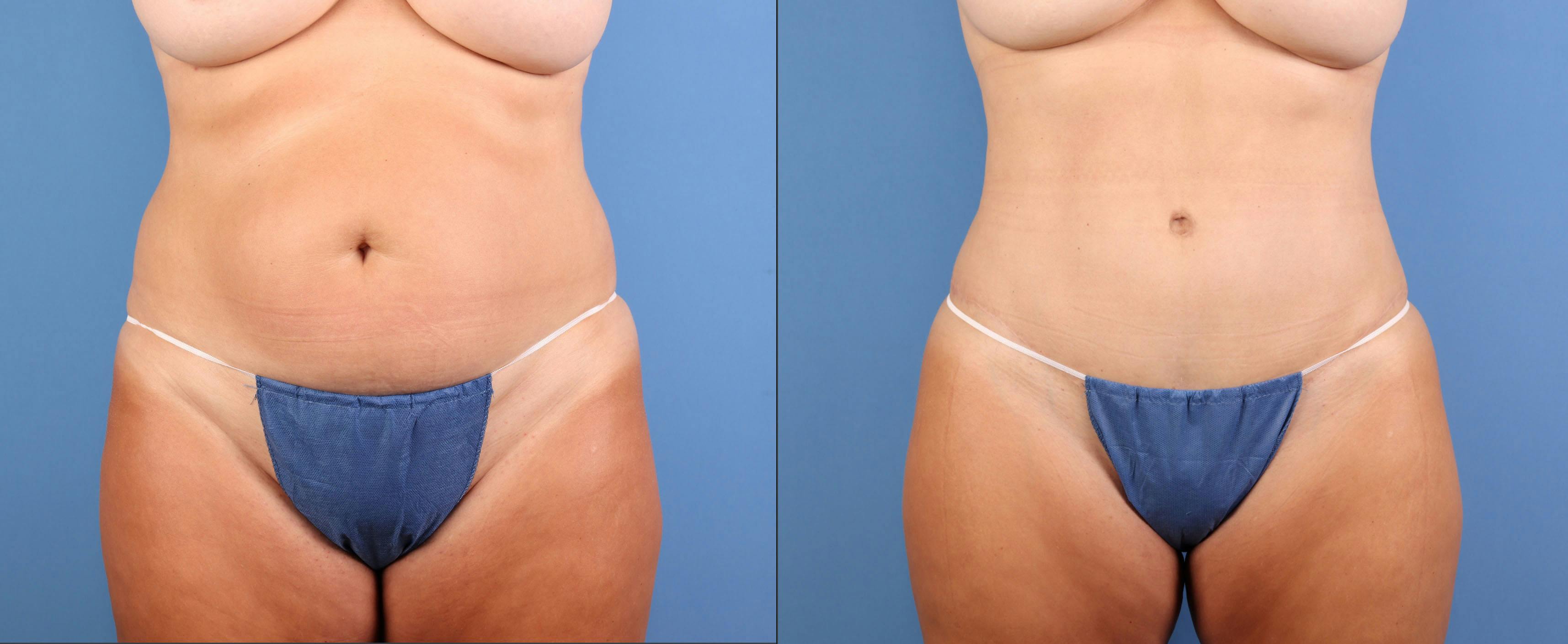 Abdomen Before & After Gallery - Patient 737335 - Image 1