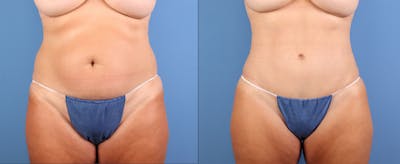 Tummy Tuck Before & After Gallery - Patient 236492 - Image 1