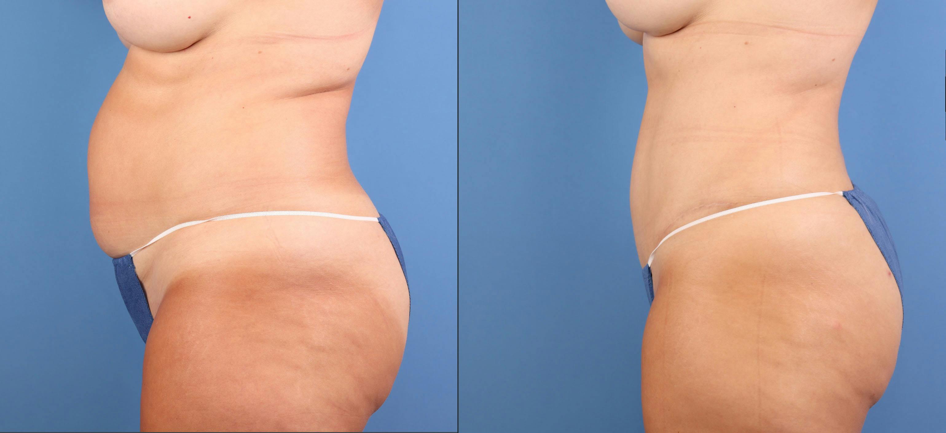 Abdomen Before & After Gallery - Patient 737335 - Image 3