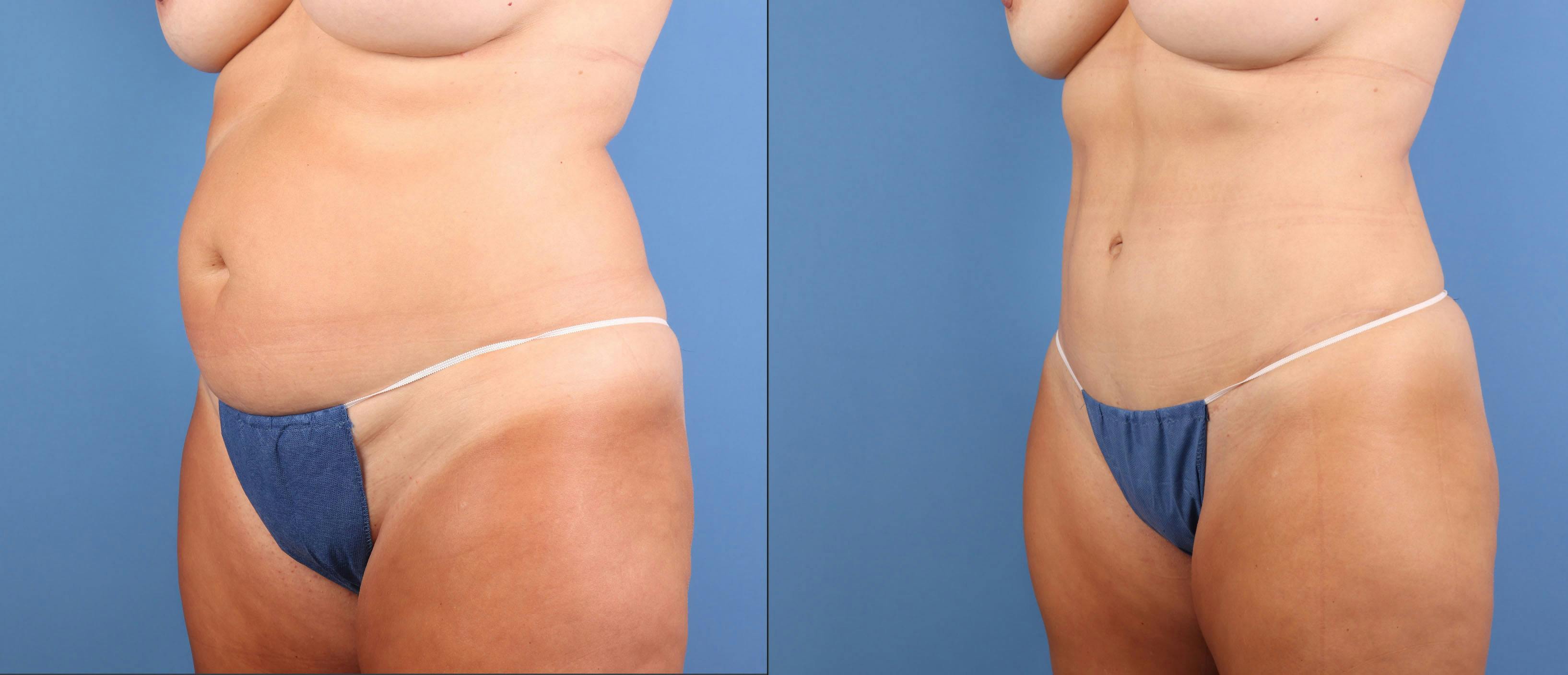 Abdomen Before & After Gallery - Patient 737335 - Image 2