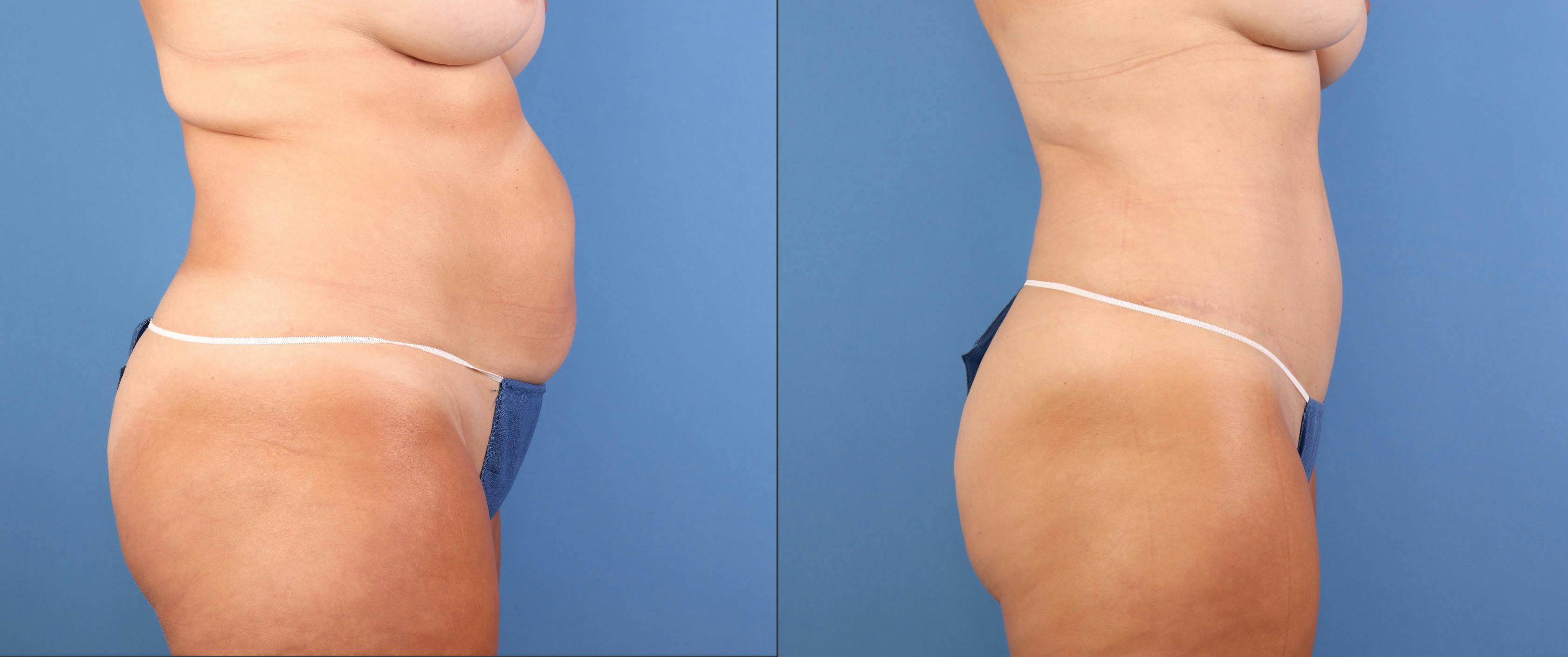 Abdomen Before & After Gallery - Patient 737335 - Image 5