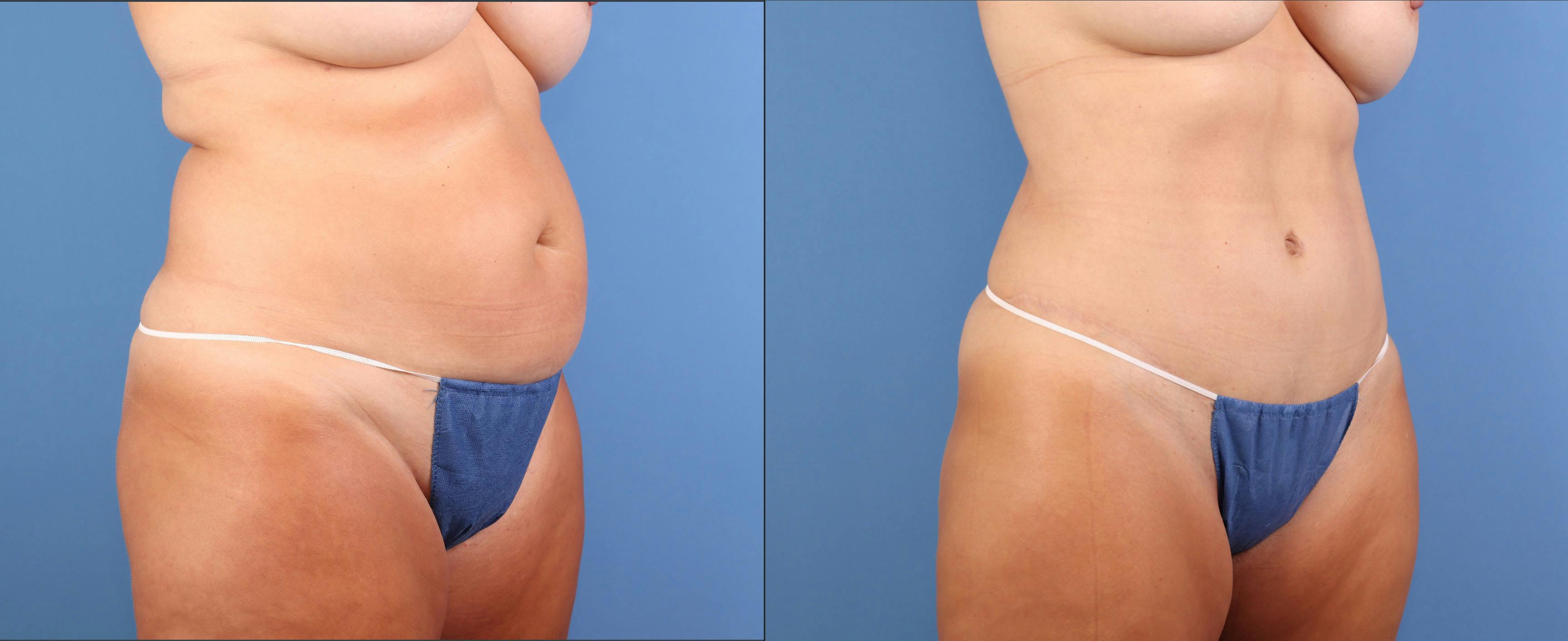 Abdomen Before & After Gallery - Patient 737335 - Image 4