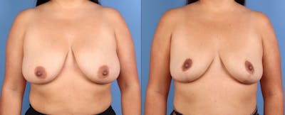 Breast Reduction Before & After Gallery - Patient 180293 - Image 1