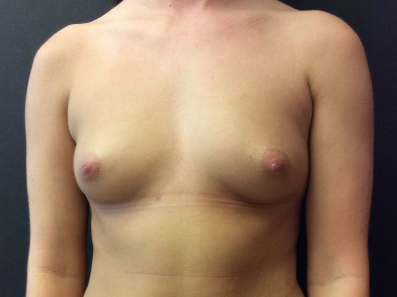 Breast Augmentation Before & After Gallery - Patient 56397872 - Image 1