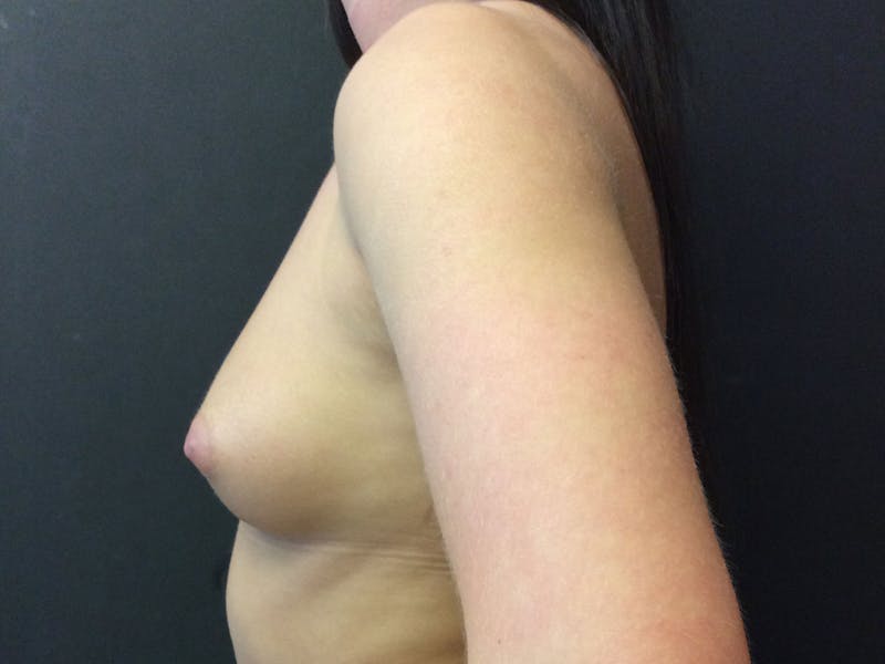 Breast Augmentation Before & After Gallery - Patient 56397872 - Image 3