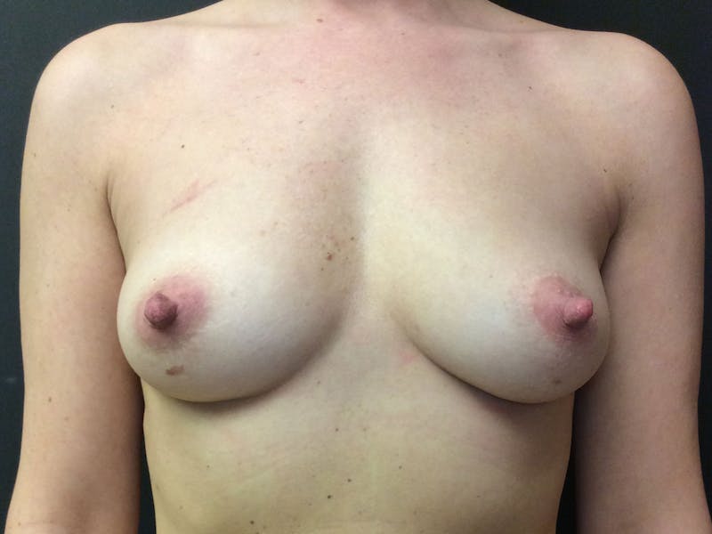Breast Augmentation Before & After Gallery - Patient 56397876 - Image 1