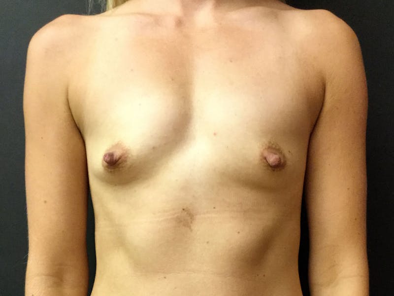 Breast Augmentation Gallery - Patient 56397877 - Image 1