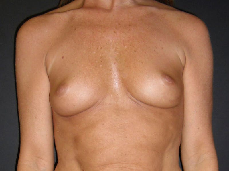 Breast Augmentation Before & After Gallery - Patient 56397879 - Image 1