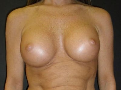Breast Augmentation Before & After Gallery - Patient 56397879 - Image 2