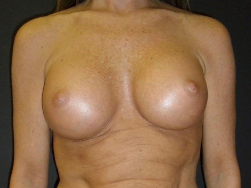 Breast Augmentation Before & After Gallery - Patient 56397879 - Image 2