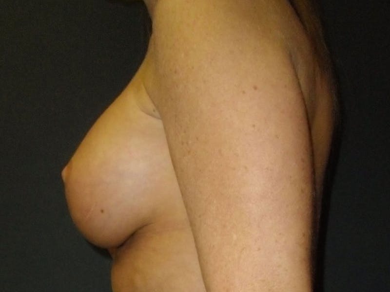 Breast Augmentation Before & After Gallery - Patient 56397879 - Image 4