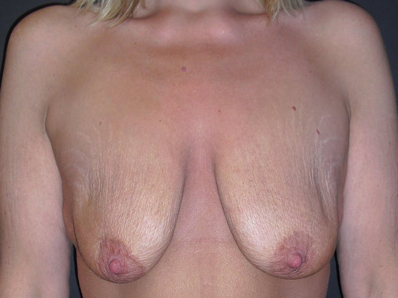 Breast Lift Before & After Gallery - Patient 56397928 - Image 1