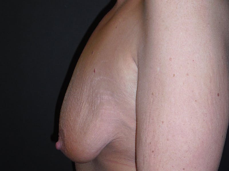 Breast Lift Before & After Gallery - Patient 56397928 - Image 3