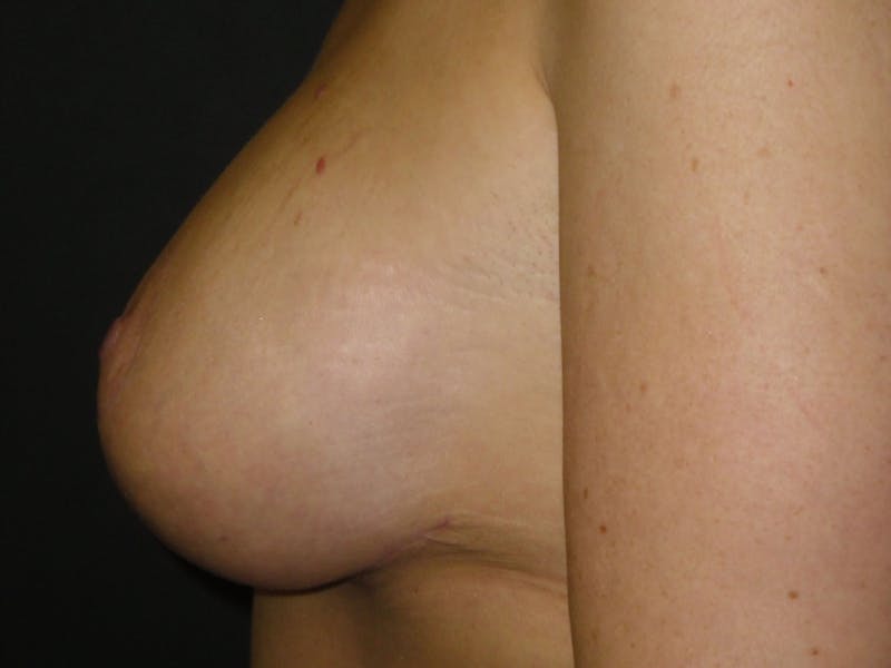 Breast Lift Before & After Gallery - Patient 56397928 - Image 4