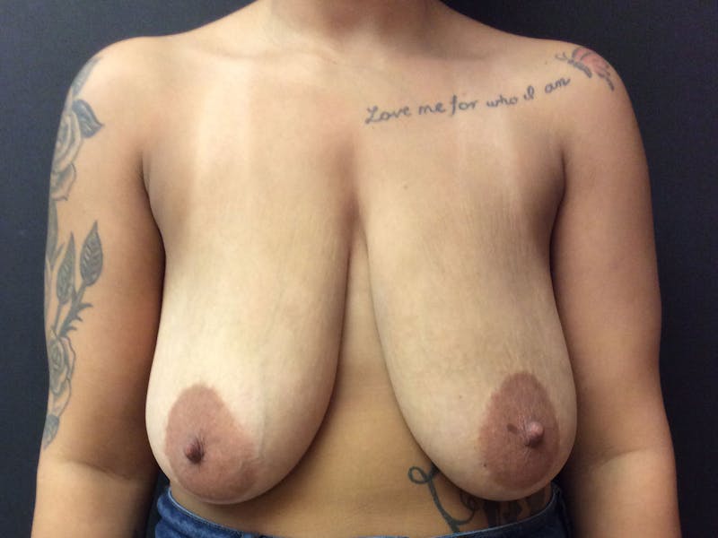 Breast Lift Before & After Gallery - Patient 56397929 - Image 1