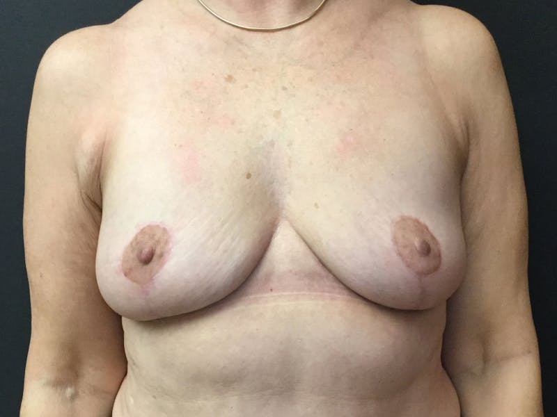 Breast Revision Before & After Gallery - Patient 56397932 - Image 2