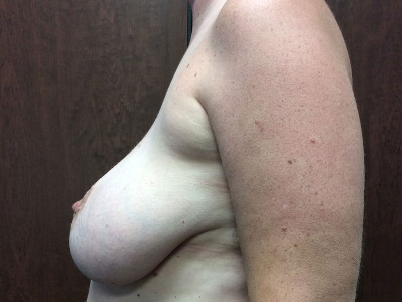 Breast Reduction Before & After Gallery - Patient 56397935 - Image 3