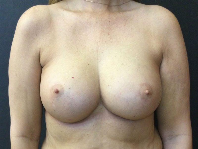 Breast Augmentation Gallery - Patient 56397874 - Image 2