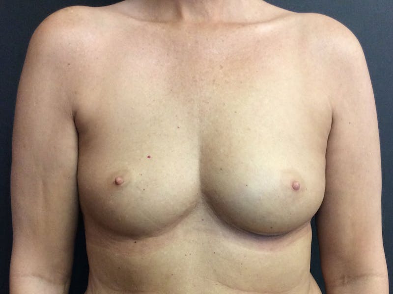 Breast Augmentation Gallery - Patient 56397874 - Image 1