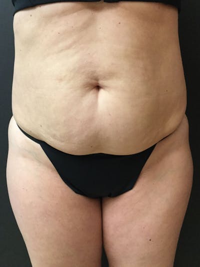 Liposuction Before & After Gallery - Patient 56533351 - Image 1