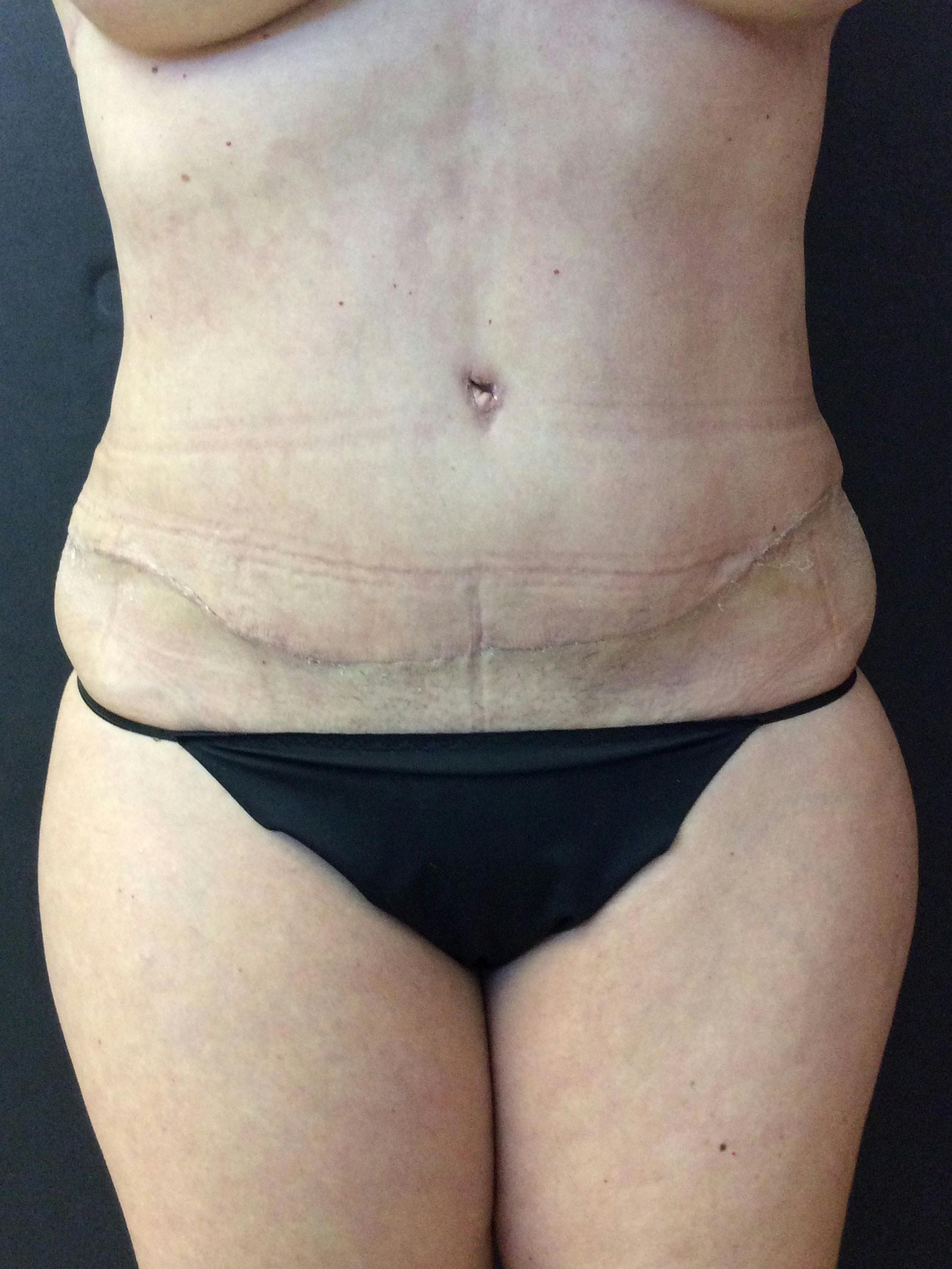 Abdominoplasty