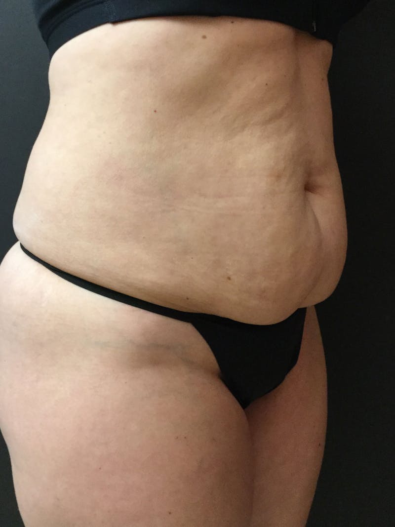 Abdominoplasty Before & After Gallery - Patient 56533357 - Image 3