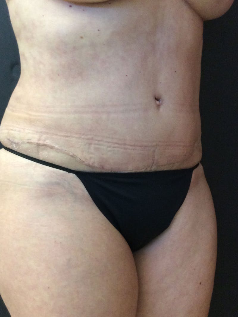 Liposuction Before & After Gallery - Patient 56533351 - Image 4