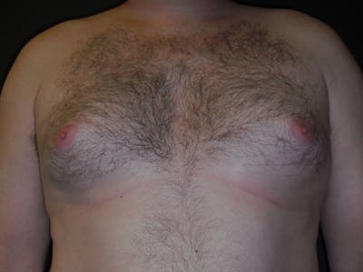 Gynecomastia Before & After Gallery - Patient 60810583 - Image 1