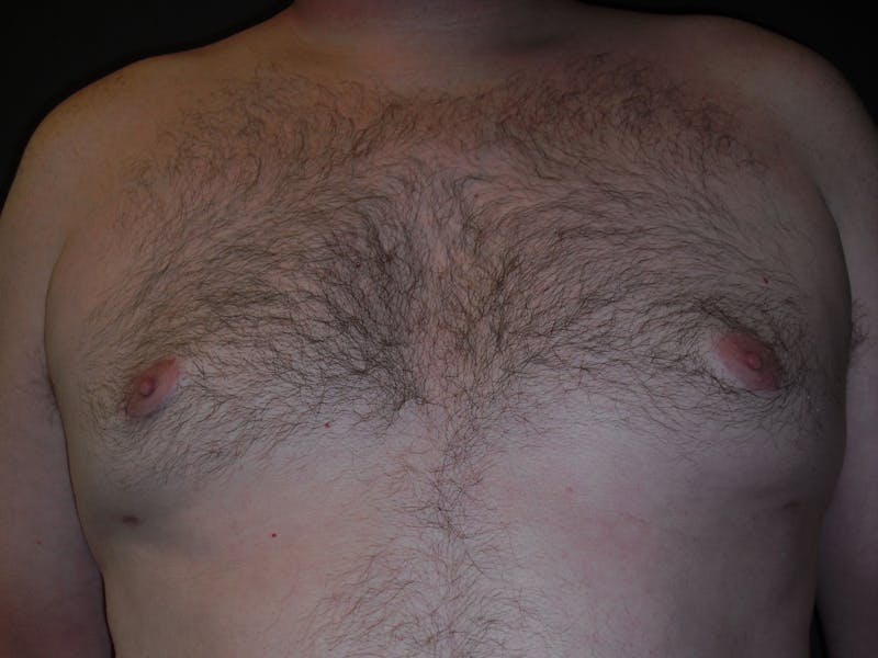 Gynecomastia Before & After Gallery - Patient 60810583 - Image 2