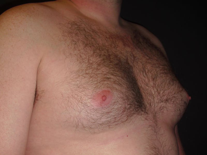 Gynecomastia Before & After Gallery - Patient 60810583 - Image 3