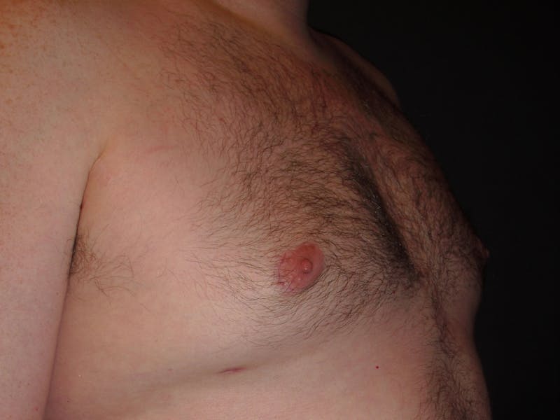 Gynecomastia Before & After Gallery - Patient 60810583 - Image 4