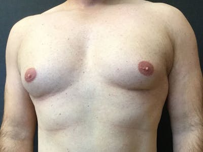 Gynecomastia Before & After Gallery - Patient 60810584 - Image 1