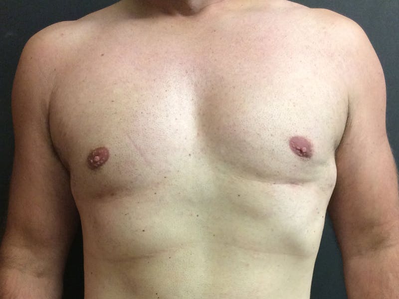 Gynecomastia Before & After Gallery - Patient 60810584 - Image 2