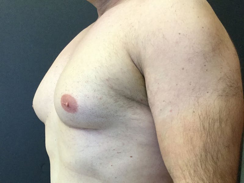 Gynecomastia Before & After Gallery - Patient 60810584 - Image 3