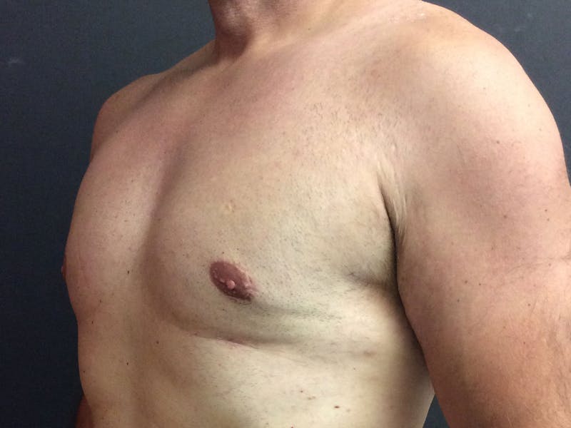 Gynecomastia Before & After Gallery - Patient 60810584 - Image 4