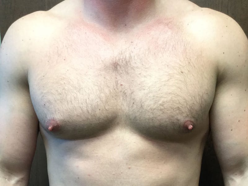 Gynecomastia Before & After Gallery - Patient 60810585 - Image 1