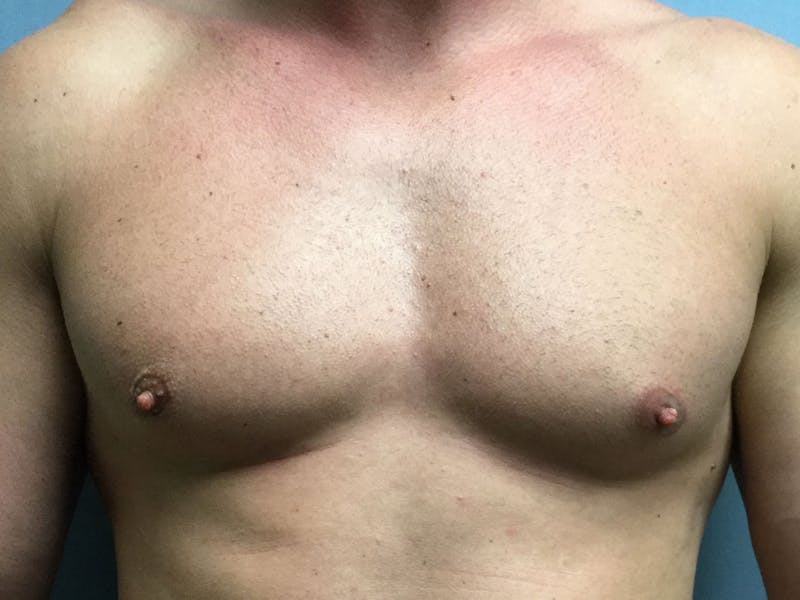 Gynecomastia Before & After Gallery - Patient 60810585 - Image 2