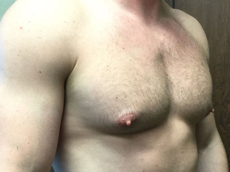 Gynecomastia Before & After Gallery - Patient 60810585 - Image 3