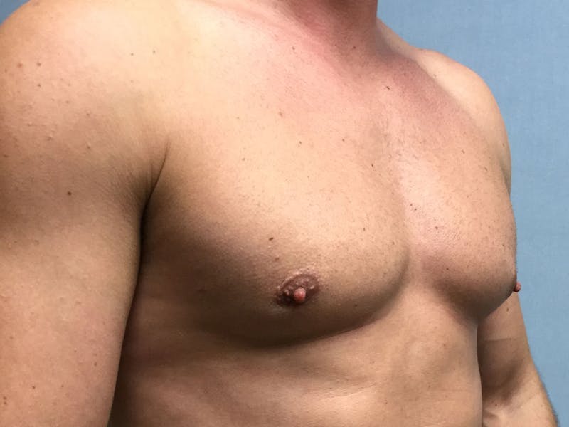 Gynecomastia Before & After Gallery - Patient 60810585 - Image 4