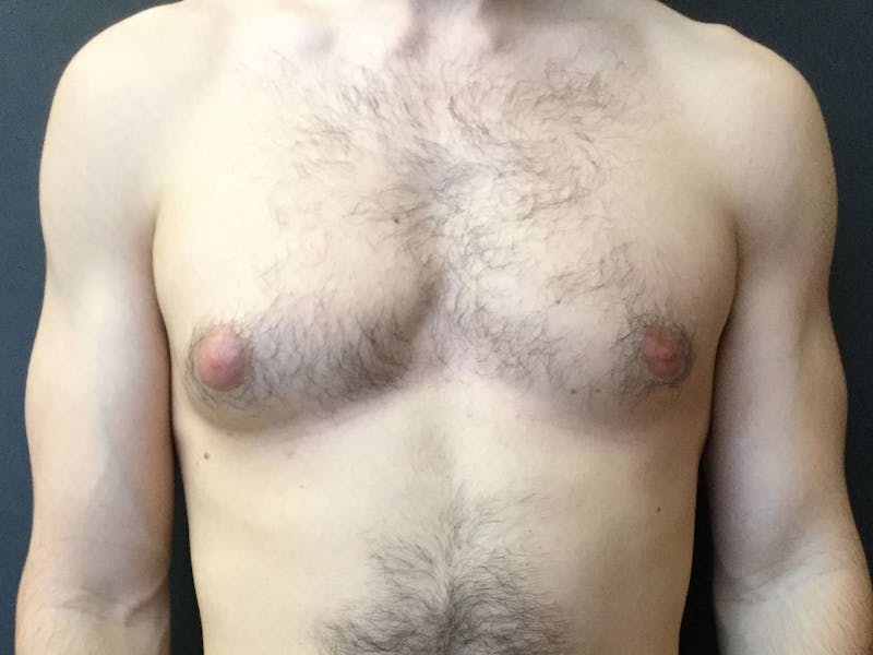 Gynecomastia Before & After Gallery - Patient 60810586 - Image 1