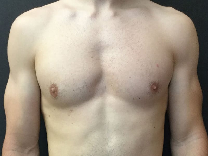 Gynecomastia Before & After Gallery - Patient 60810586 - Image 2