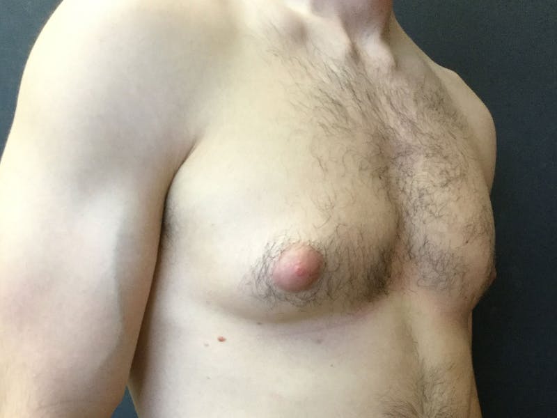 Gynecomastia Before & After Gallery - Patient 60810586 - Image 3
