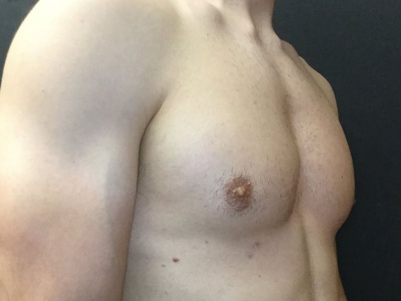 Gynecomastia Before & After Gallery - Patient 60810586 - Image 4