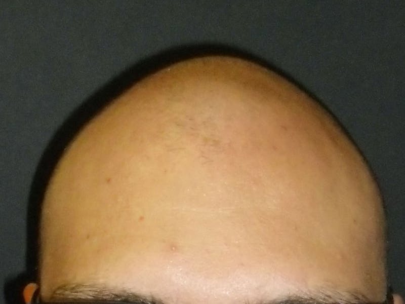 Hair Restoration Before & After Gallery - Patient 76071941 - Image 1
