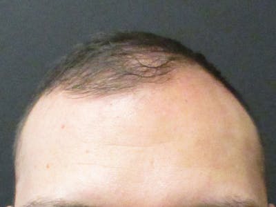 Hair Restoration Before & After Gallery - Patient 76071941 - Image 2