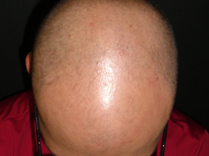 Hair Restoration Before & After Gallery - Patient 76071941 - Image 3