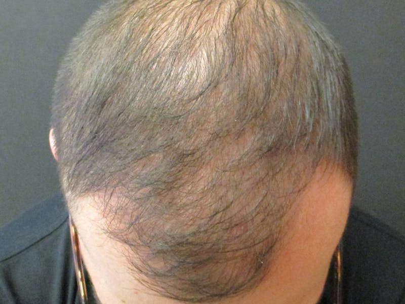 Hair Restoration Before & After Gallery - Patient 76071941 - Image 4
