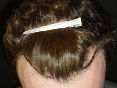 Hair Restoration Gallery - Patient 76073021 - Image 1