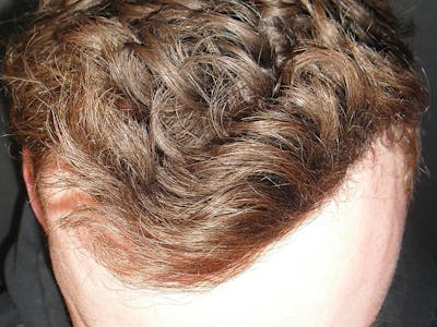 Hair Restoration Before & After Gallery - Patient 76073021 - Image 2