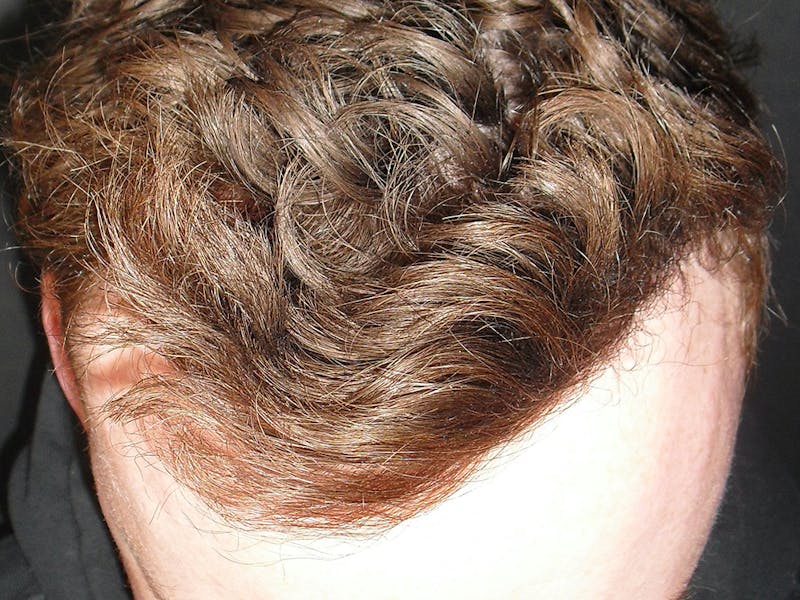 Hair Restoration Before & After Gallery - Patient 76073021 - Image 2